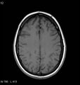 Neurosarcoidosis (Radiopaedia 10930-11351 Axial T1 14).jpg