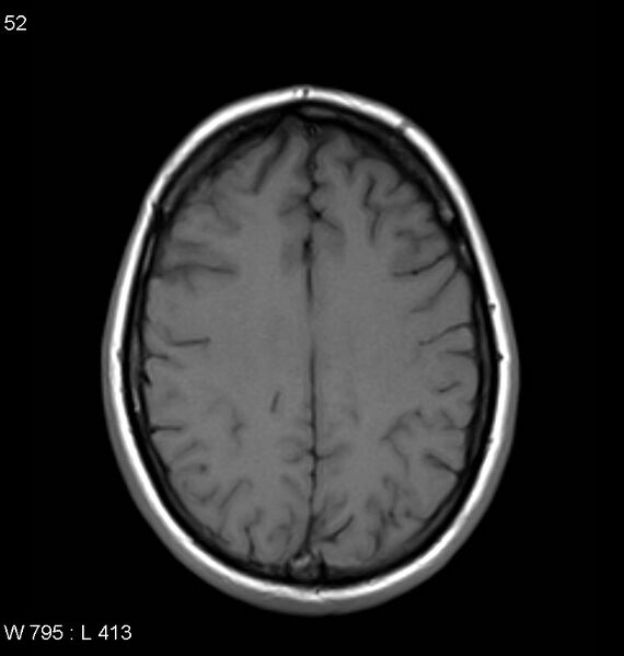 File:Neurosarcoidosis (Radiopaedia 10930-11351 Axial T1 14).jpg