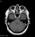 Neurosarcoidosis (Radiopaedia 10930-11351 Axial T1 C+ 5).jpg