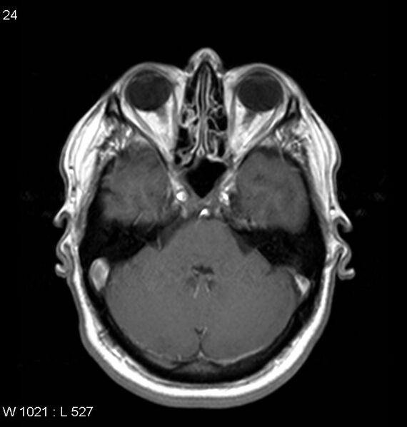 File:Neurosarcoidosis (Radiopaedia 10930-11351 Axial T1 C+ 5).jpg