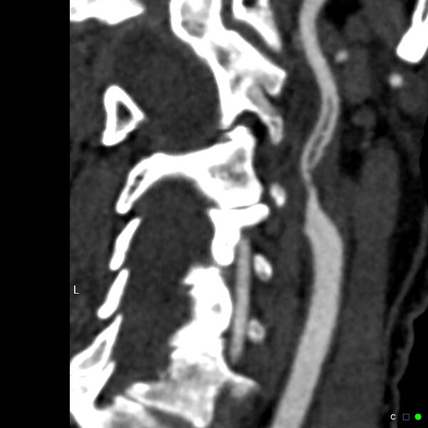 File:Non-occlusive intraluminal internal carotid artery thrombus (Radiopaedia 37751-39658 A 30).jpg