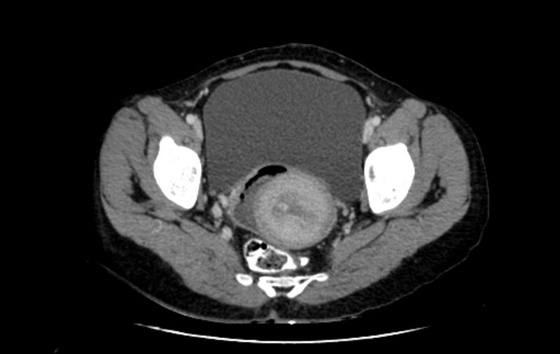 File:Non-puerperal uterine inversion (Radiopaedia 78343-91094 A 39).jpg