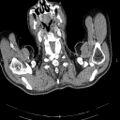 Non Hodgkin lymphoma in a patient with ankylosing spondylitis (Radiopaedia 84323-99621 B 1).jpg