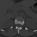 Normal CT lumbar spine (Radiopaedia 53981-60118 Axial bone window 5).jpg