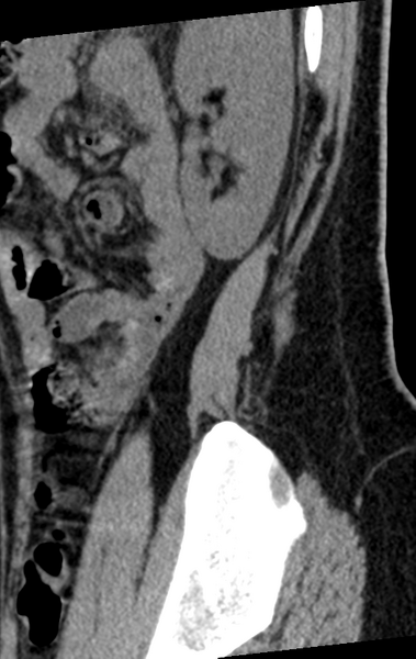 File:Normal lumbar spine CT (Radiopaedia 46533-50986 C 5).png