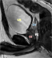Normal prostate (MRI) (Radiopaedia 29986-30536 F 1).png