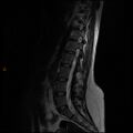 Normal spine MRI (Radiopaedia 77323-89408 Sagittal T2 9).jpg