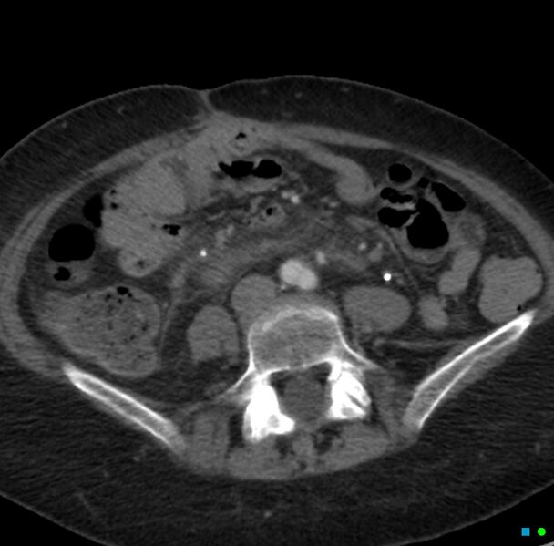 File:Obstructed infected horseshoe kidney (Radiopaedia 18116-17898 B 25).jpg