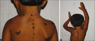 a) Marked elevation of left scapula b)restriction of abduction