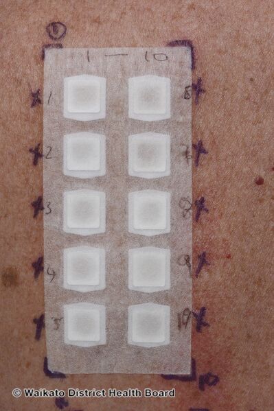 File:Patch tests applied to skin of upper back (DermNet NZ patch-test-series-013).jpg