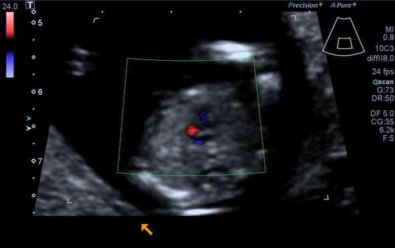 File:1st trimester nuchal-morphology ultrasound (Radiopaedia 44706-48477 Heart views cine with colour 127).jpg