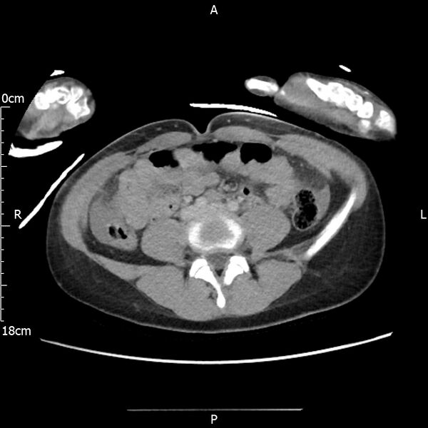 File:AAST grade IV kidney injury with CEUS follow-up (Radiopaedia 72353-82877 Axial C+ portal venous phase 45).jpg