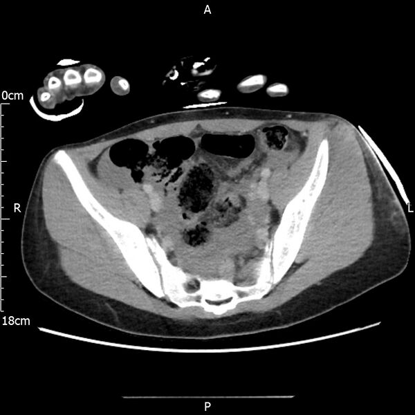 File:AAST grade IV kidney injury with CEUS follow-up (Radiopaedia 72353-82877 Axial C+ portal venous phase 61).jpg