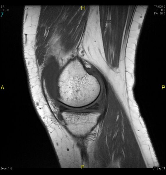 File:ACL mucoid degeration with cystic changes (Radiopaedia 48428-53341 Sagittal T1 5).jpg