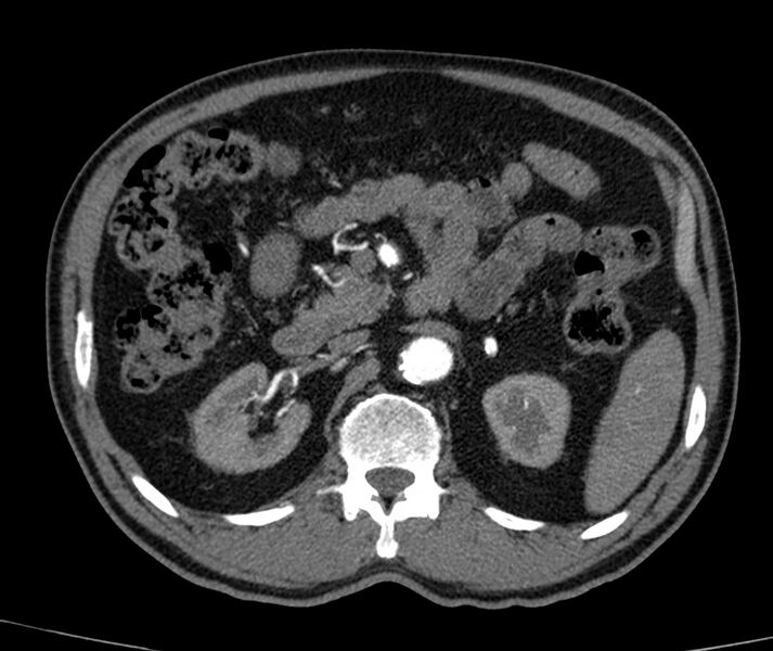 File:Abdominal aortic aneurysm (Radiopaedia 22421-22458 C+ arterial phase 26).jpg