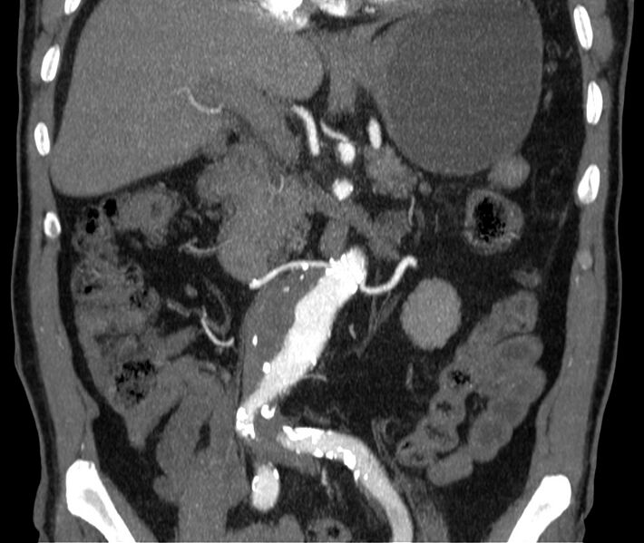 File:Abdominal aortic aneurysm (Radiopaedia 22421-22458 C 19).jpg