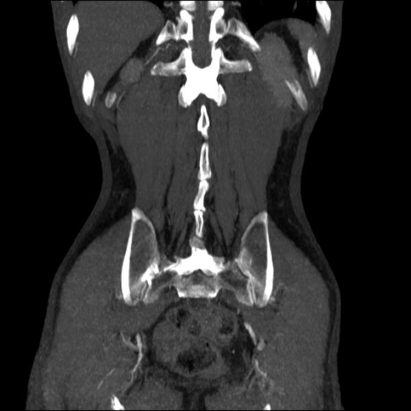File:Abdominal aortic aneurysm (Radiopaedia 23703-23856 Coronal C+ arterial phase 31).jpg