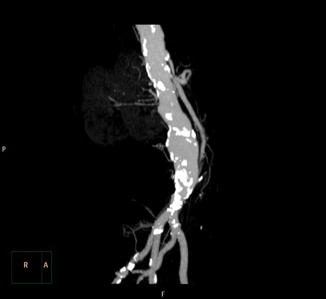 File:Abdominal aortic aneurysm (Radiopaedia 23703-23856 MIP 6).jpg