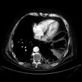 Abdominal aortic aneurysm (Radiopaedia 25855-26001 Axial C+ arterial phase 13).jpg