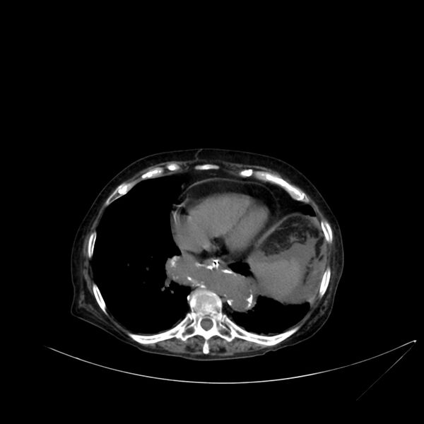 File:Abdominal aortic aneurysm - impending rupture (Radiopaedia 19233-19246 Axial non-contrast 16).jpg