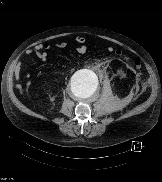 File:Abdominal aortic aneurysm with intramural hematoma then rupture (Radiopaedia 50278-55632 Axial C+ arterial phase 100).jpg