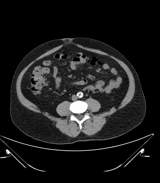 File:Abdominal aortic aneurysm with thrombus fissuration (Radiopaedia 46218-50618 Axial non-contrast 33).jpg