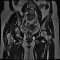 Abdominal wall endometriosis (Radiopaedia 83702-98847 Coronal T2 10).jpg