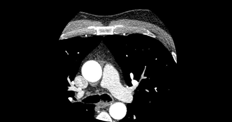 File:Aberrant left main coronary artery (ALMCA) arising from the right sinus with interarterial course (Radiopaedia 63251-71814 Axial C+ arterial phase 5).JPG