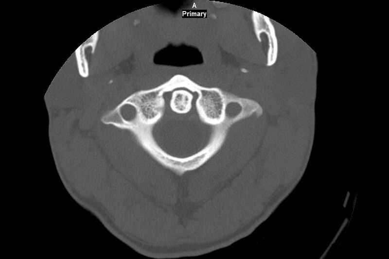 File:Accessory ossicle of the anterior arch of C1 vertebra (Radiopaedia 58149-65211 Axial bone window 7).jpg