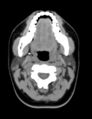 Accessory parotid glands (Radiopaedia 27289-27472 Axial non-contrast 5).jpg
