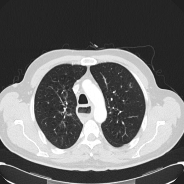 File:Achalasia (Radiopaedia 24937-25206 Axial lung window 9).jpg