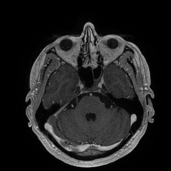 File:Acoustic schwannoma - intracanalicular (Radiopaedia 37247-39024 Axial T1 C+ 77).jpg