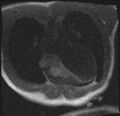 Active right ventricular cardiac sarcoidosis (Radiopaedia 55596-62100 Axial Dynamic perfusion scan MOCO 26).jpg