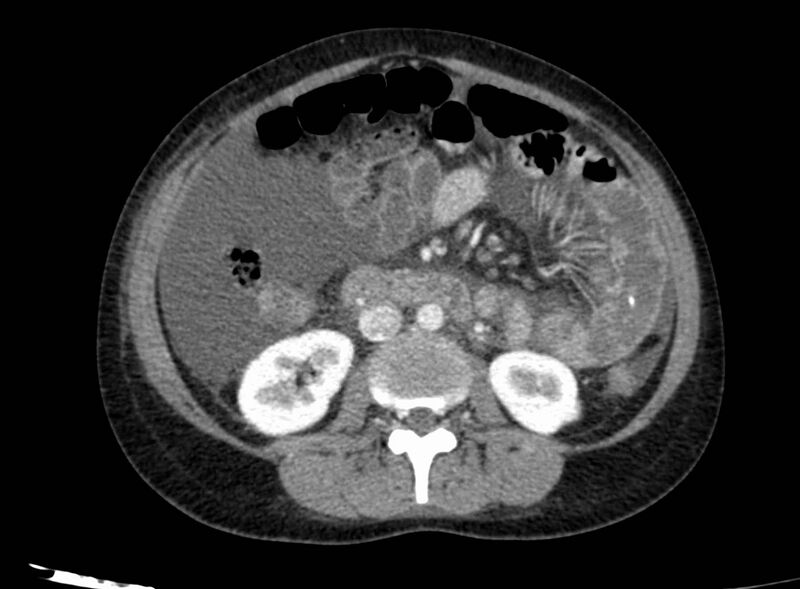 File:Acute Budd-Chiari syndrome (Radiopaedia 60858-68638 Axial C+ portal venous phase 149).jpg