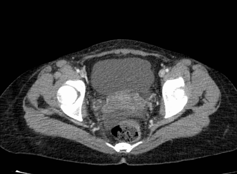 File:Acute Budd-Chiari syndrome (Radiopaedia 60858-68638 Axial C+ portal venous phase 274).jpg