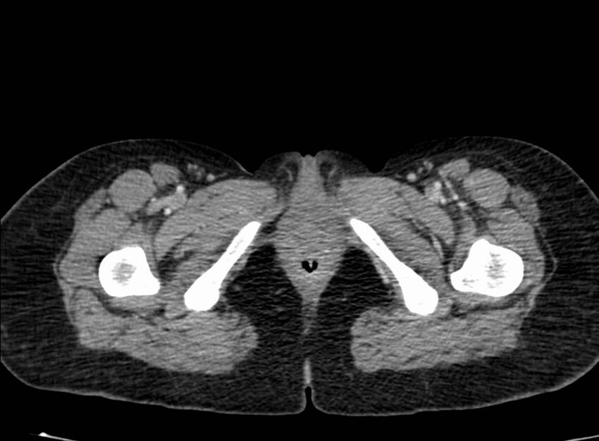 Acute Budd-Chiari syndrome (Radiopaedia 60858-68638 Axial C+ portal venous phase 317).jpg