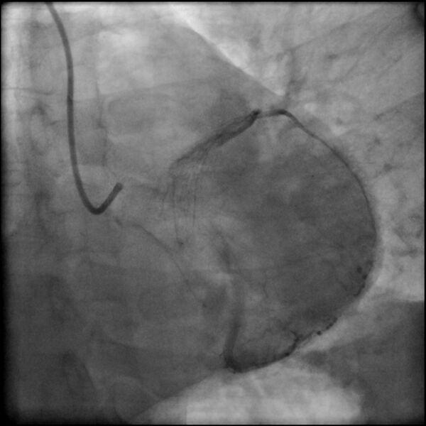 File:Acute anteroseptal myocardial infarction (Radiopaedia 68409-77946 LAO caudal (spider view) LAD and CX 59).jpg