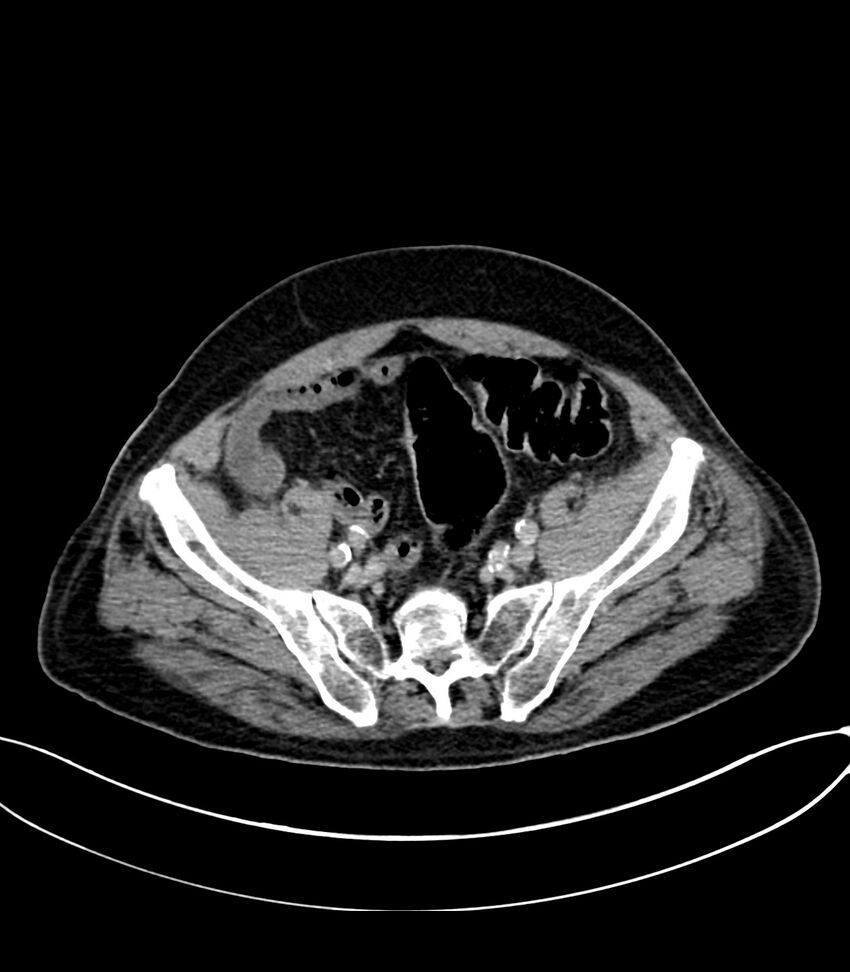 Acute arterial mesenteric ischemia (Radiopaedia 78238-90828 Axial C+ delayed 113).jpg