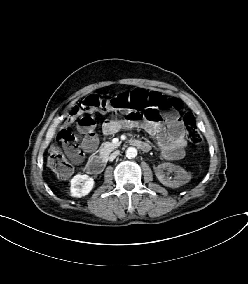 Acute arterial mesenteric ischemia (Radiopaedia 78238-90828 Axial C+ portal venous phase 59).jpg