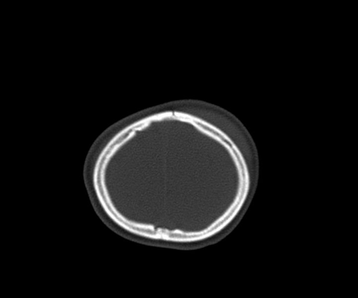 File:Acute epidural hematoma (Radiopaedia 63659-72335 Axial bone window 32).jpg