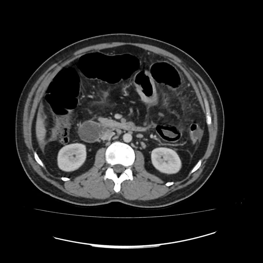 Acute mesenteric ischemia - superior mesenteric artery thrombosis (Radiopaedia 73947-84776 Axial C+ portal venous phase 54).jpg