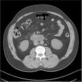 Acute pancreatitis - mild (Radiopaedia 27796-28033 Axial non-contrast 25).jpg