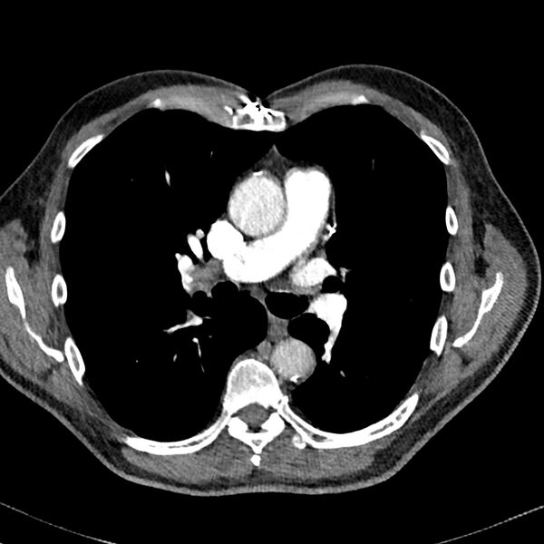 File:Acute pulmonary embolism (Radiopaedia 81677-95570 Axial C+ CTPA 39).jpg