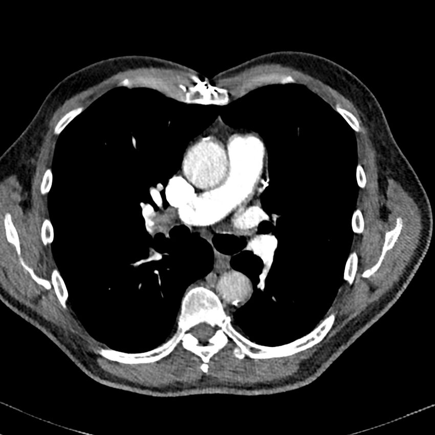 Acute pulmonary embolism (Radiopaedia 81677-95570 Axial C+ CTPA 39).jpg