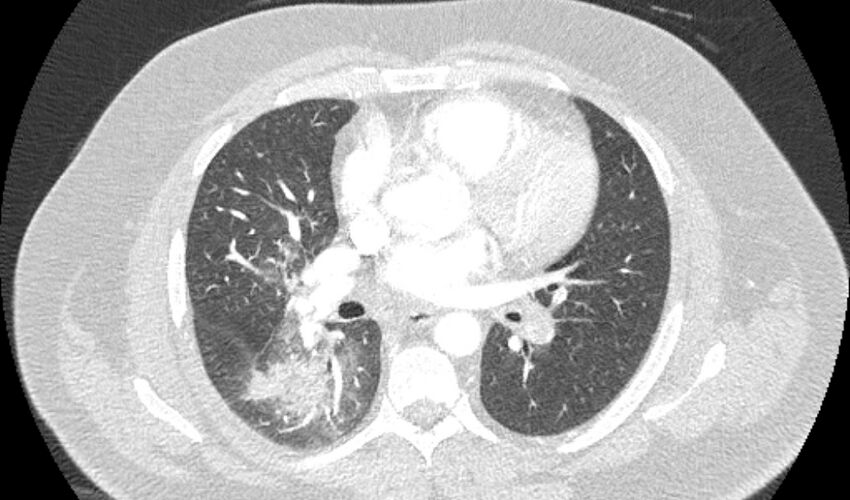 Acute pulmonary embolism with pulmonary infarcts (Radiopaedia 77688-89908 Axial lung window 60).jpg
