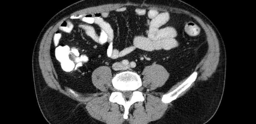 Acute sigmoid colon diverticulitis (Radiopaedia 55507-61976 Axial C+ portal venous phase 48).jpg