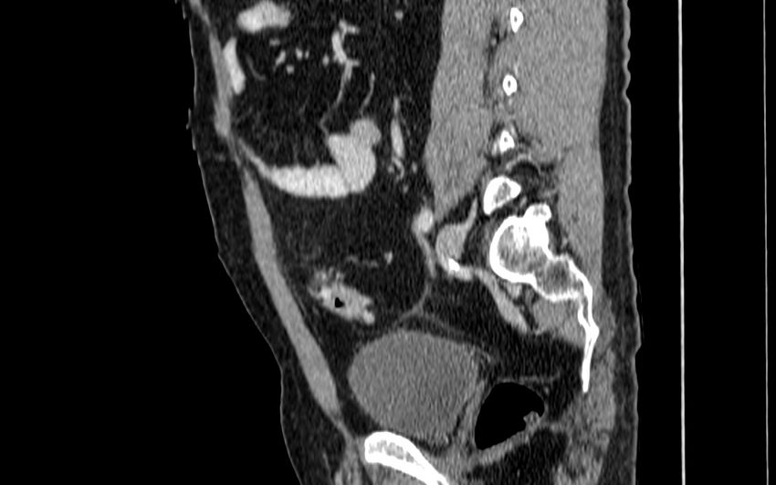 Acute sigmoid colon diverticulitis (Radiopaedia 55507-61976 Sagittal C+ portal venous phase 31).jpg