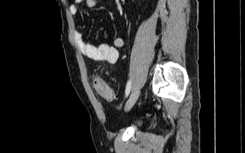 File:Acute sigmoid colon diverticulitis (Radiopaedia 55507-61976 Sagittal C+ portal venous phase 53).jpg