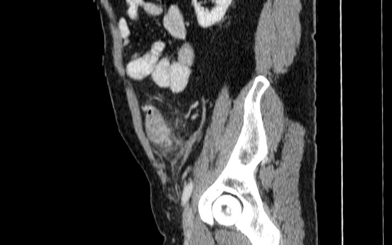 File:Acute sigmoid colon diverticulitis (Radiopaedia 55507-61976 Sagittal C+ portal venous phase 80).jpg