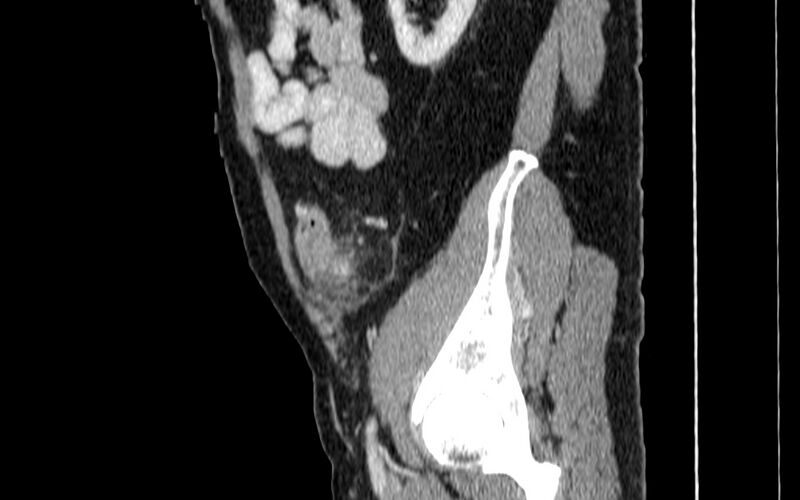 File:Acute sigmoid colon diverticulitis (Radiopaedia 55507-61976 Sagittal C+ portal venous phase 92).jpg